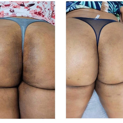 Bleaching Kit