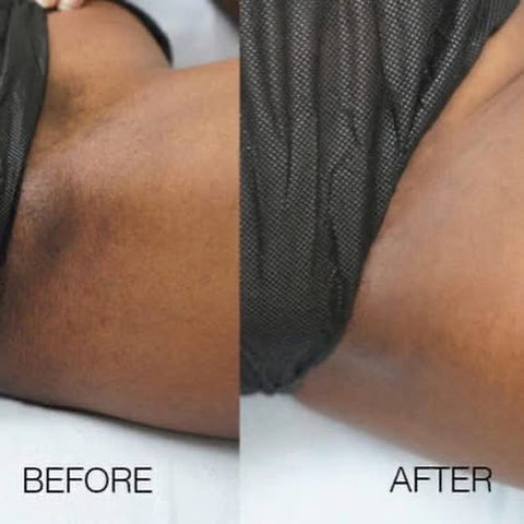Bleaching Kit